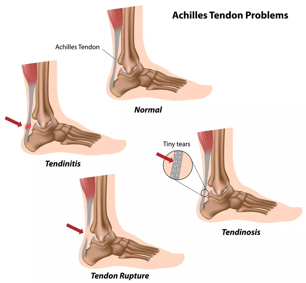 Achilles tendor injurnies