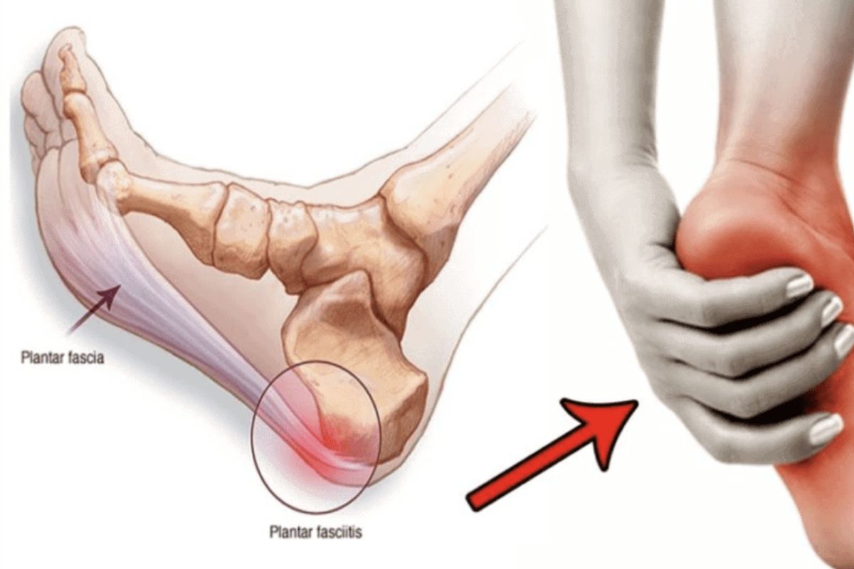 Plantar fasciitis can also cause numbness in the toes when running