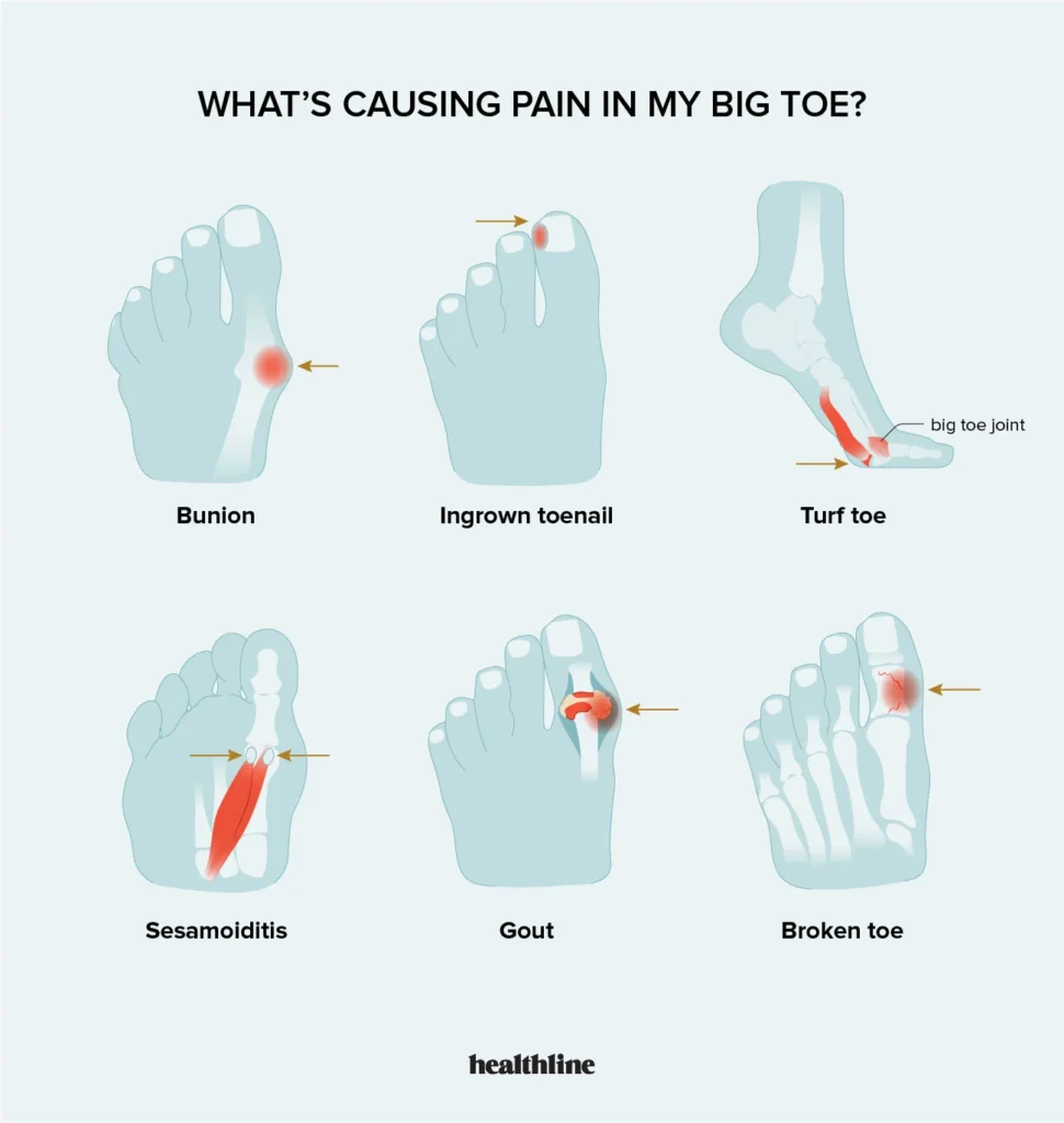 Why Does Big Toe Hurt After Running: 7 Causes and 14 Solutions