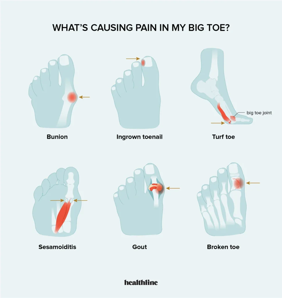 Why Does Big Toe Hurt After Running 7 Causes And 14 Solutions