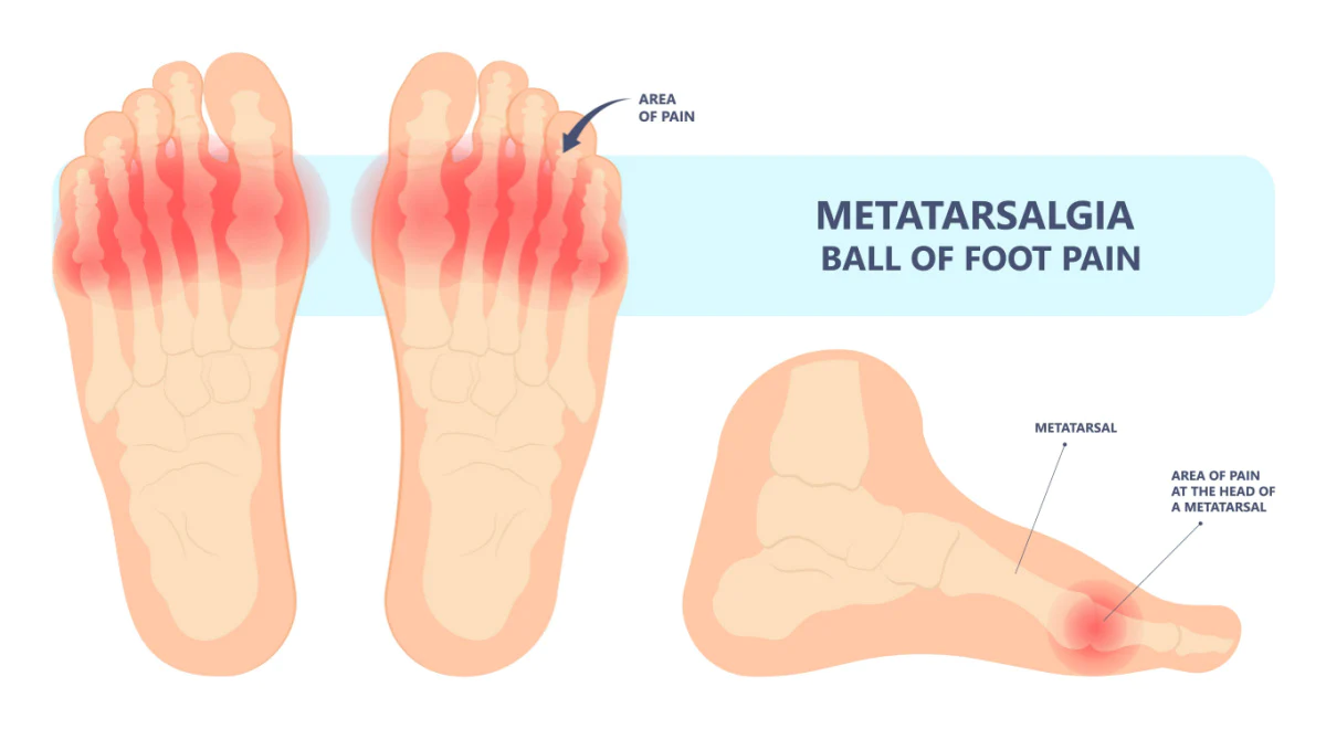 Ball of foot pain or Metatarsalgia causes pain
