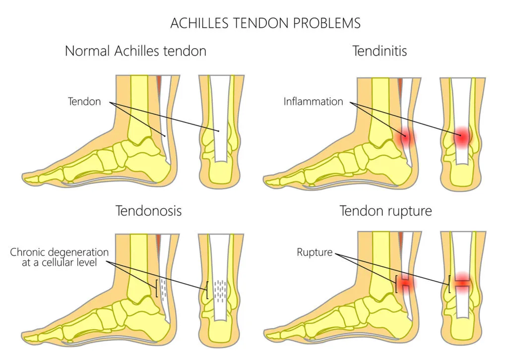 Achilles tendinopathy injuries