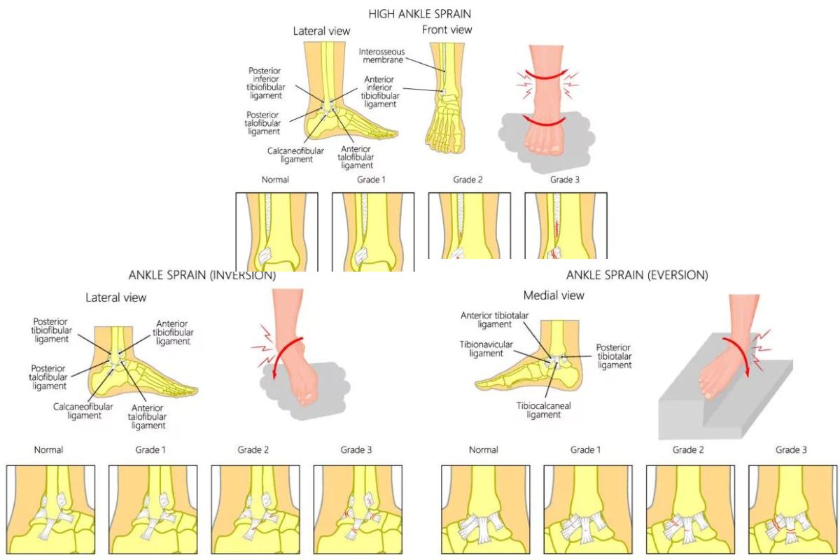 Type of ankle sprain Injuries
