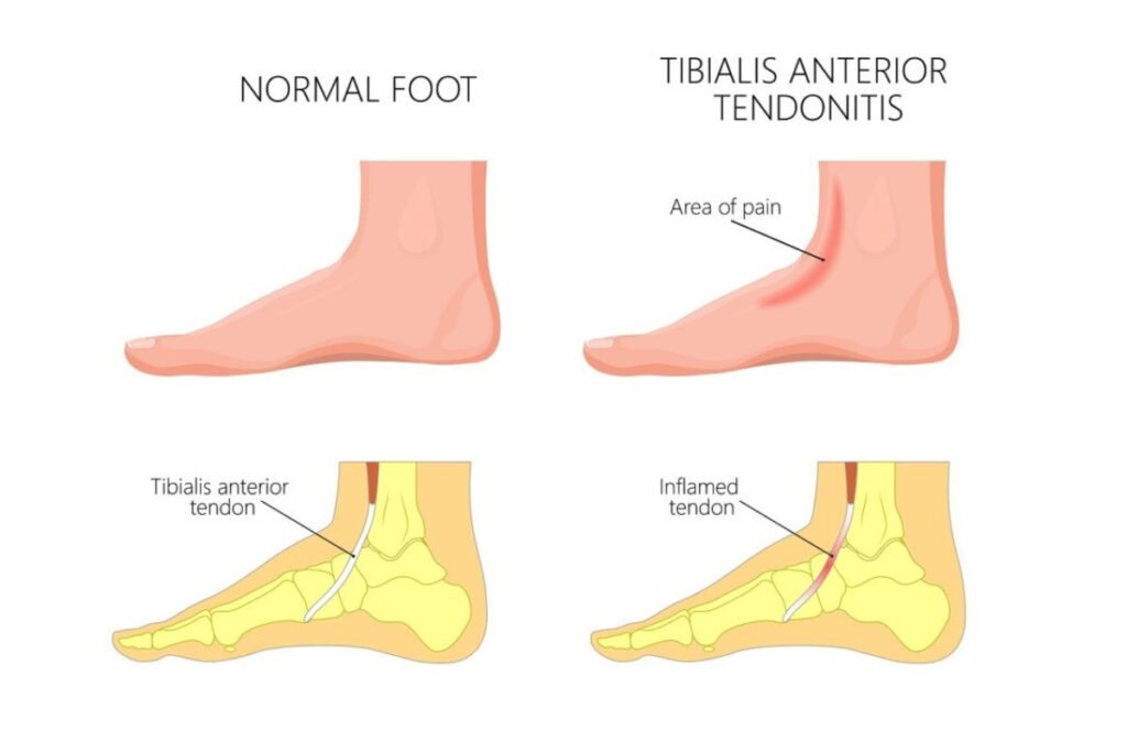 Anterior tibialis tendonitis injuries