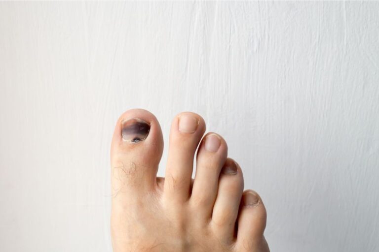 Why Do Runners' Toenails Fall Off? Causes and Tips to Avoid It