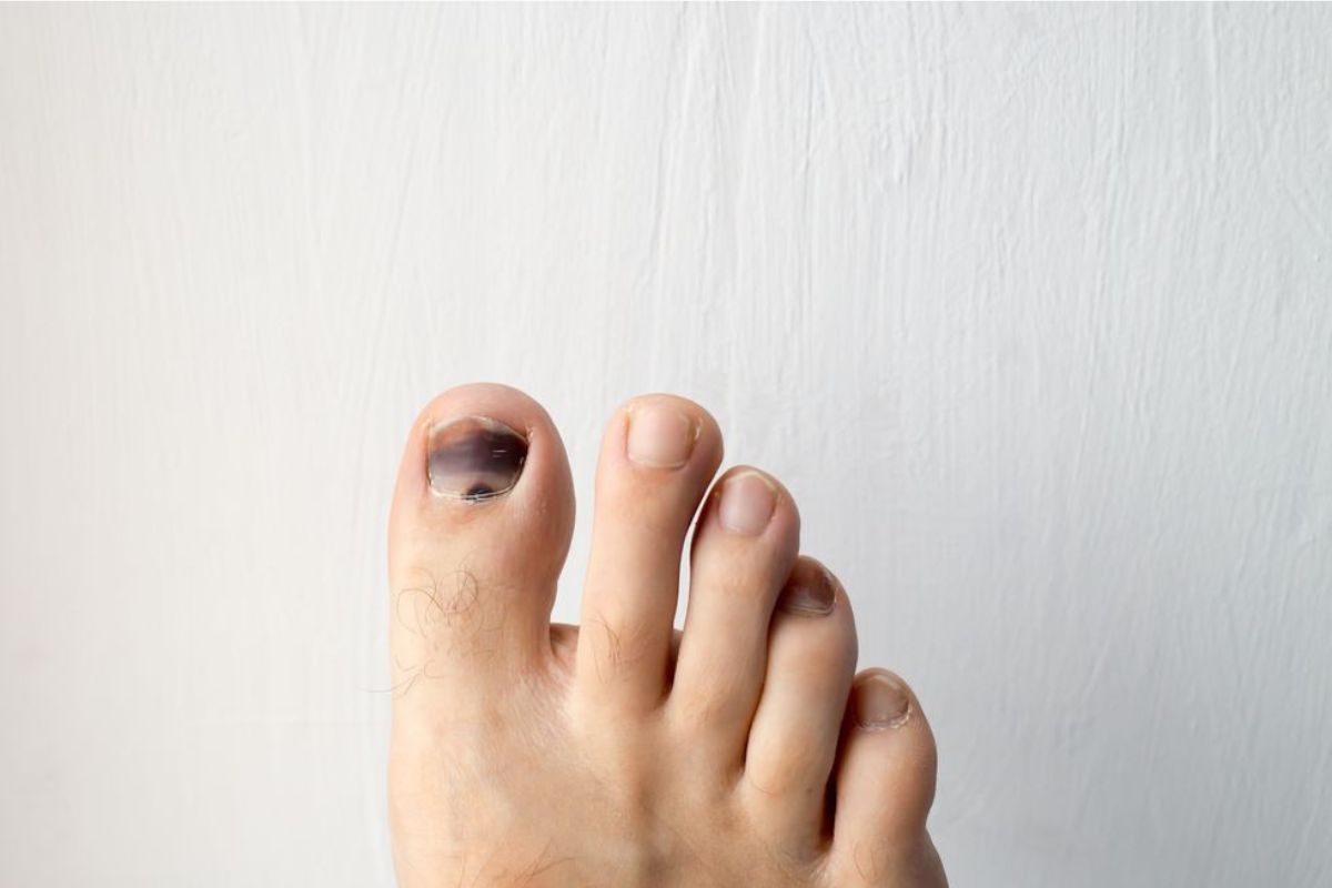 Eexample of nail discoloration while running