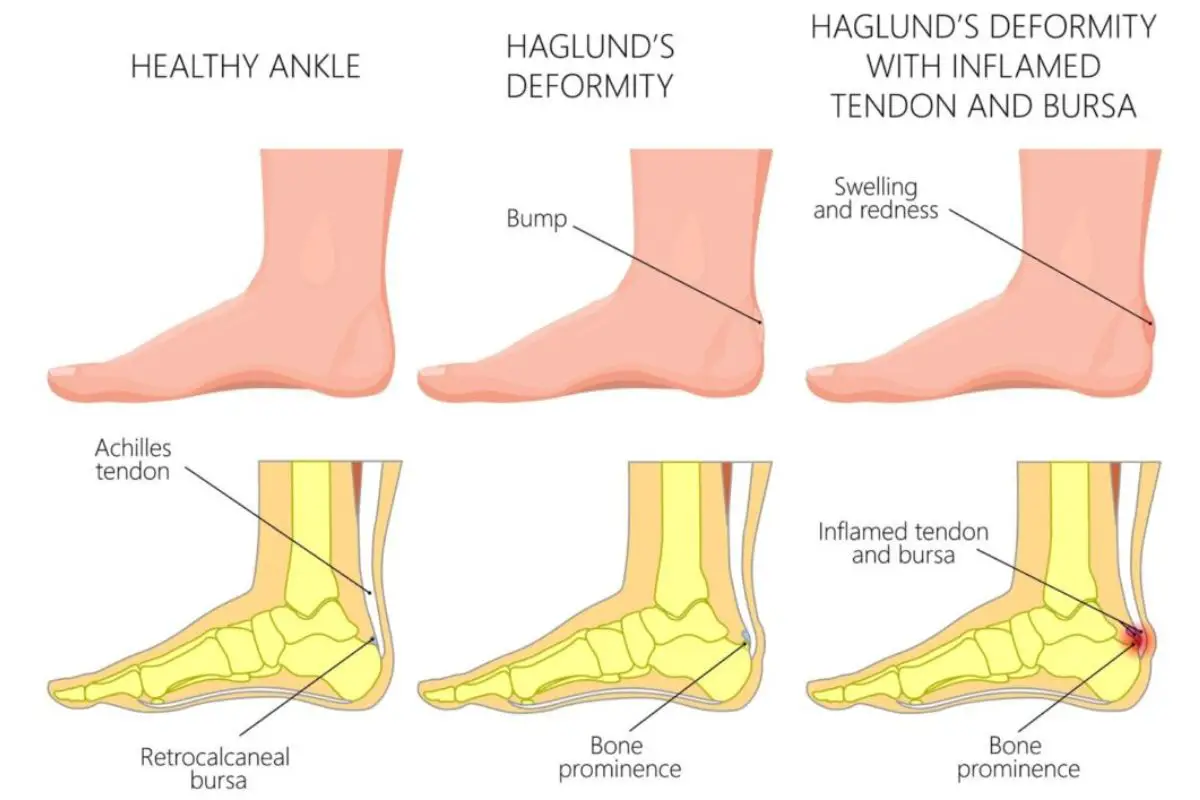 Haglund’s deformity