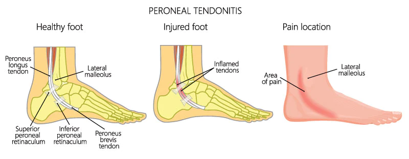 Peroneal tendonitis injuries