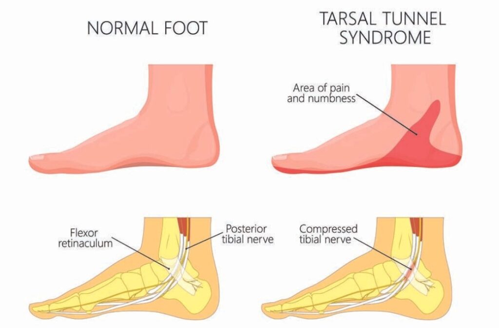 Ankles Tarsal Tunnel syndrome