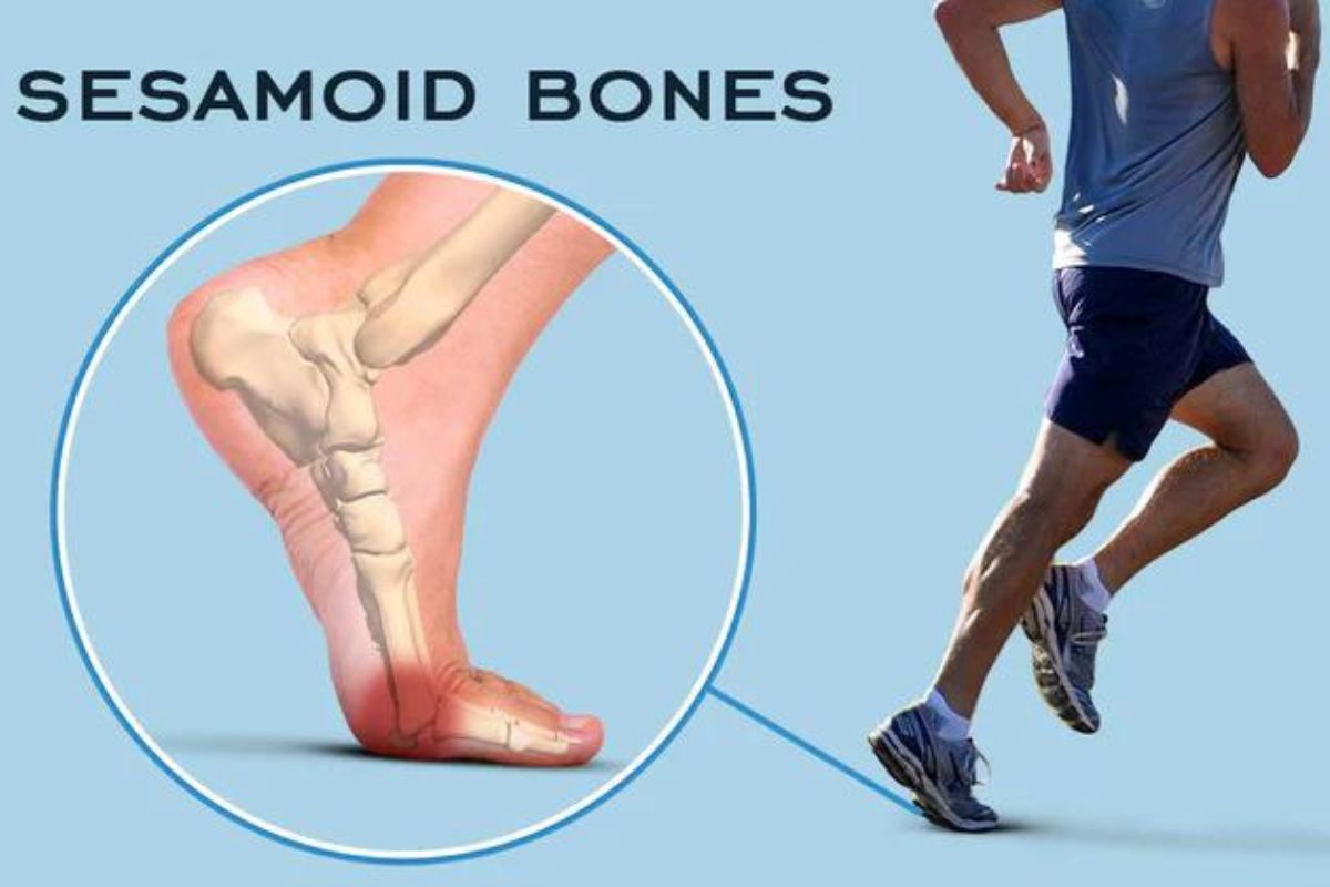 How look sesamoiditis bones when runner run