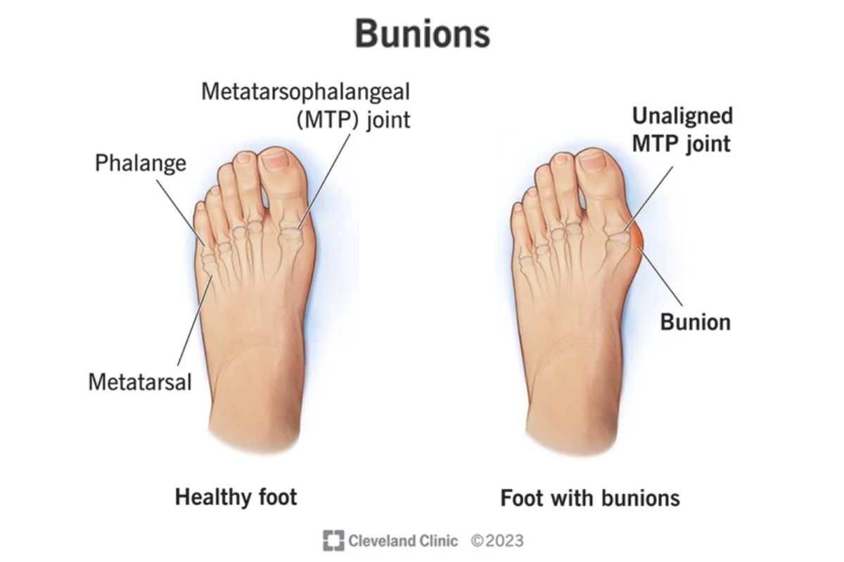 The bunions example